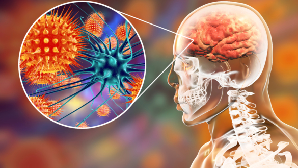 Hjärnhinneinflammation (meningit): orsak, symtom & vaccination